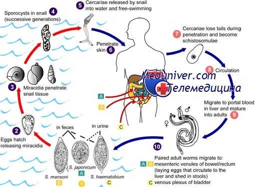 шистосомоз глаз