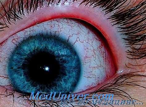 поражение глаз при кори