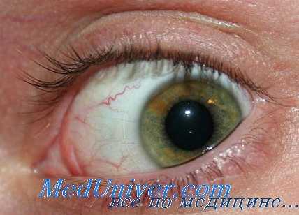 токсокароз глаз