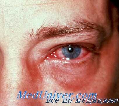 глаз при эпидемического сыпном тифе