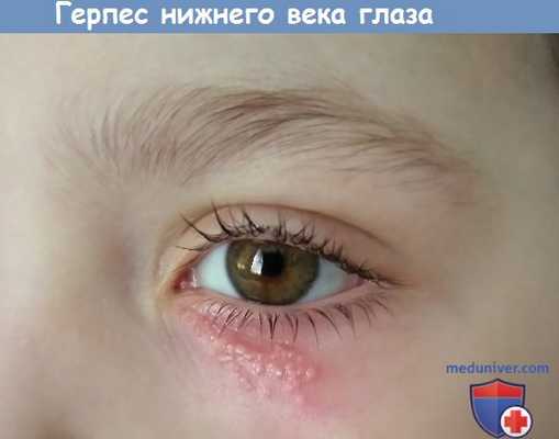 глаза при герпесной инфекции