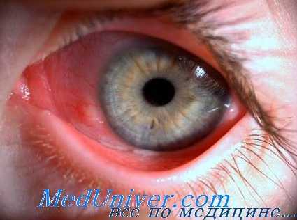энтеровирусная инфекция глаза