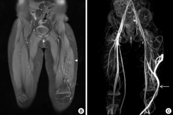 МРТ нижней конечности. Расширенная поверхностная венозная сеть и гипертрофия мягких тканей. Белая стрелка - эмбриональная боковая краевая вена.
