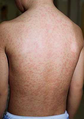 Сыпь, вызванная вирусом краснухи