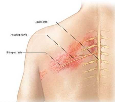 Локализация опоясывающего герпеса