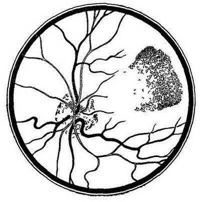 Кровоизлияние в сетчатку при лучевой болезни