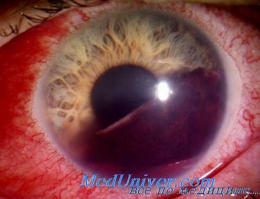 лептоспироз глаз