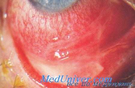 поражение глаз при болезни бехчета