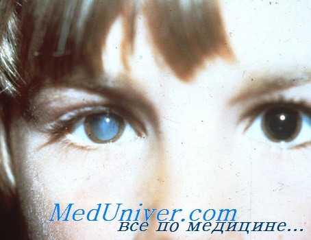 ларвальный эндофтальмит