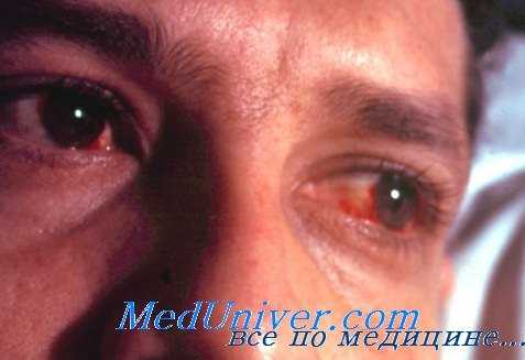 трихинеллез глаз