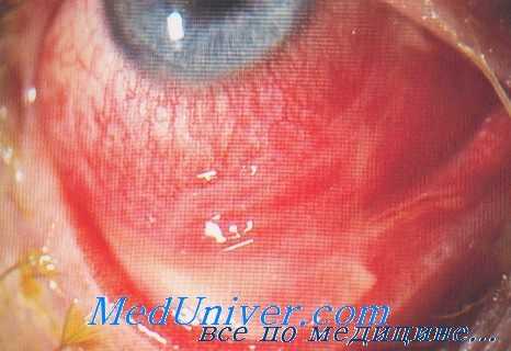 цистоцеркоз глаз