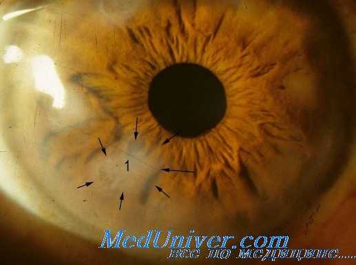 поражение глаз при вич-инфекции