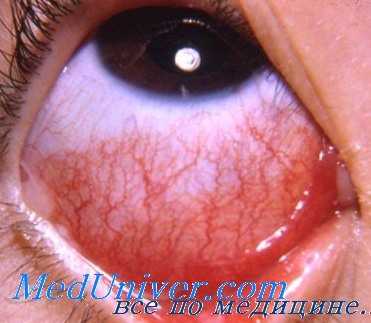 ангиостронгилез глаз