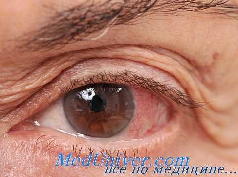 лямблиоз глаз