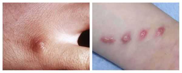 Первичный очаг заболевания