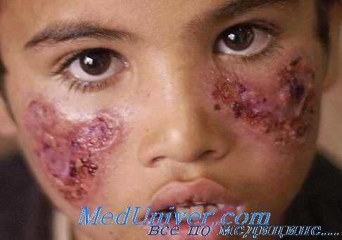 лечение лейшманиоза глаз