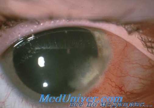 трихинеллез глаз