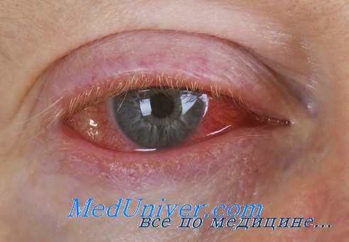 вирусные поражения глаз