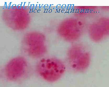 менингококковый менингит