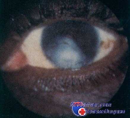 поражение глаз при лейшманиозе