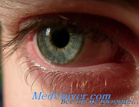 поражение глаз при дирофиляриозе