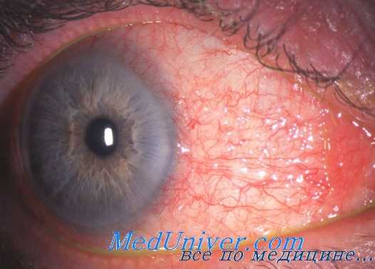 глаза при бруцеллезе