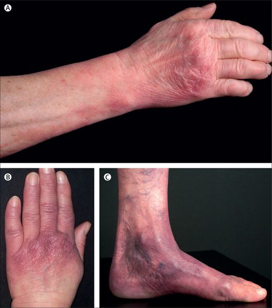 Атрофический акродерматит [10]