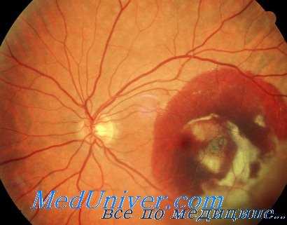 поражение организма свинцом