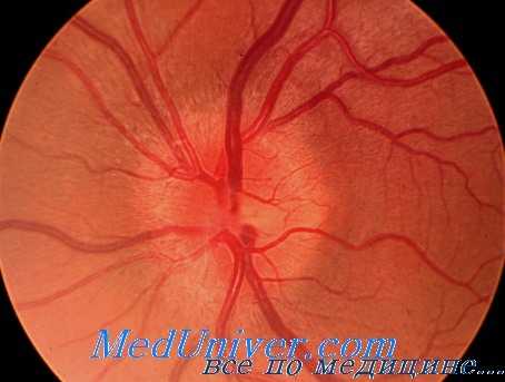 сетчатка при поражении тетраэтилсвинцом