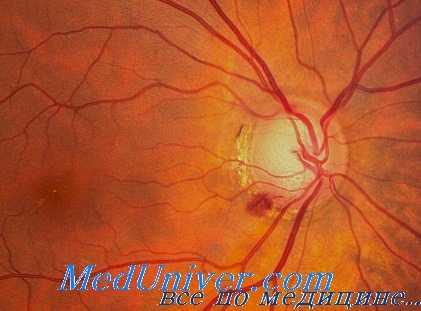 влияние тетраэтилсвинца на микроциркуляцию глаза