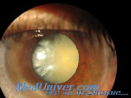 тринитротолуоловая катаракта