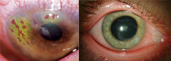 Офтальмогерпес