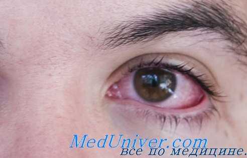 глаза при ветрянке