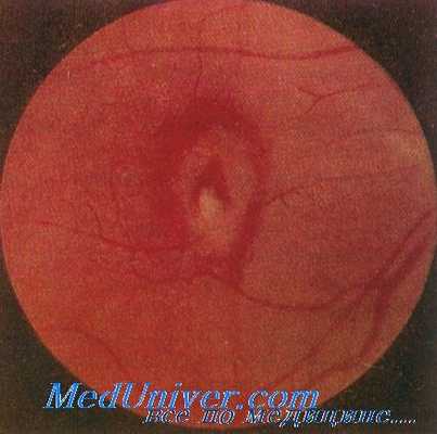 макулопатия от применения хлорохина