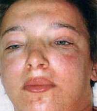 Гломерулонефрит у детей