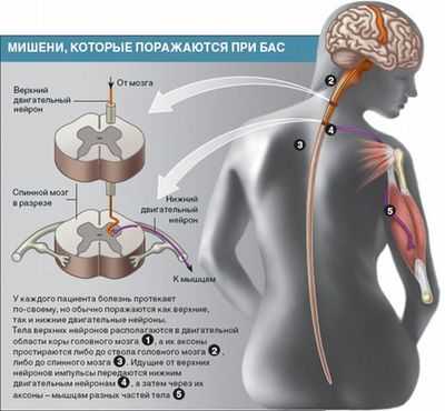 боковой амиотрофический склероз