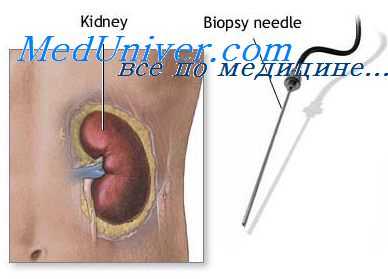 почки при кишечных инфекциях