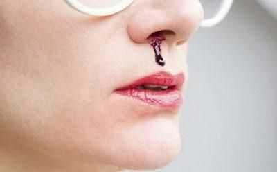 Кровь из носа