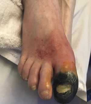 Безболевая ишемия миокарда