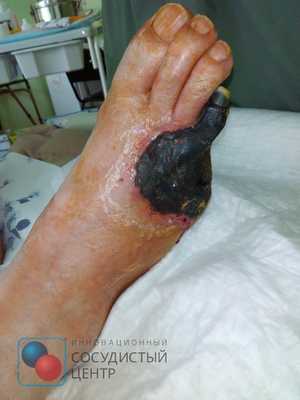 Безболевая ишемия миокарда