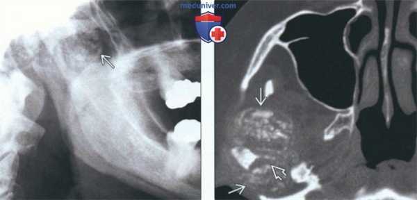 Рентгенограмма, КТ, МРТ при болезни накопления кальция пирофосфата дигидрата в височно-нижнечелюстном суставе (ВНЧС)