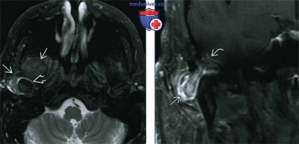 Поражение височно-нижнечелюстного сустава (ВНЧС) при болезни депонирования пирофосфата кальция дигидрата - лучевая диагностика