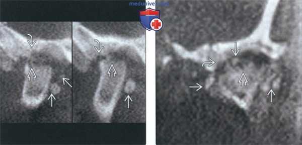 Рентгенограмма, КТ, МРТ при болезни накопления кальция пирофосфата дигидрата в височно-нижнечелюстном суставе (ВНЧС)