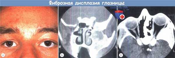 Фиброзная дисплазия глазницы у ребенка