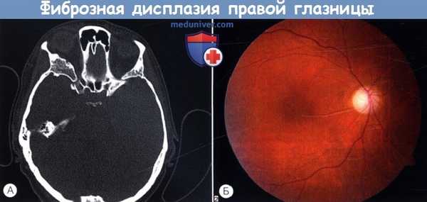 Фиброзная дисплазия правой глазницы