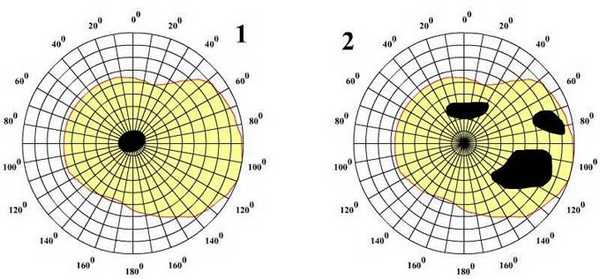 формы скотомы