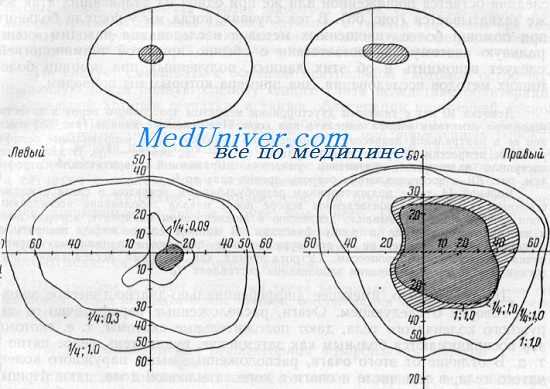 болезни зрительного нерва - скотома