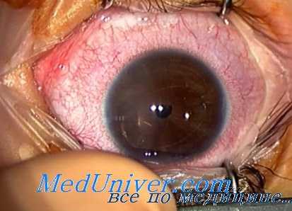 динитрофеноловая катаракта