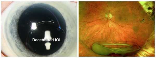 Смещение и выпадение ИОЛ в стекловидное тело