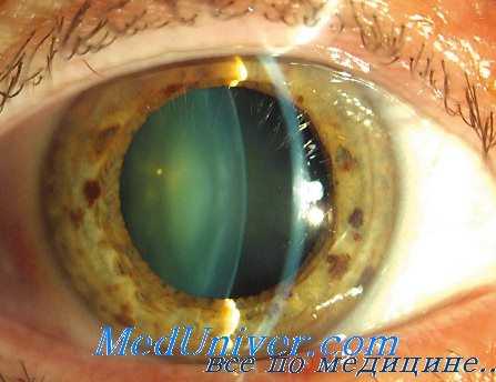 тринитротолуоловая катаракта